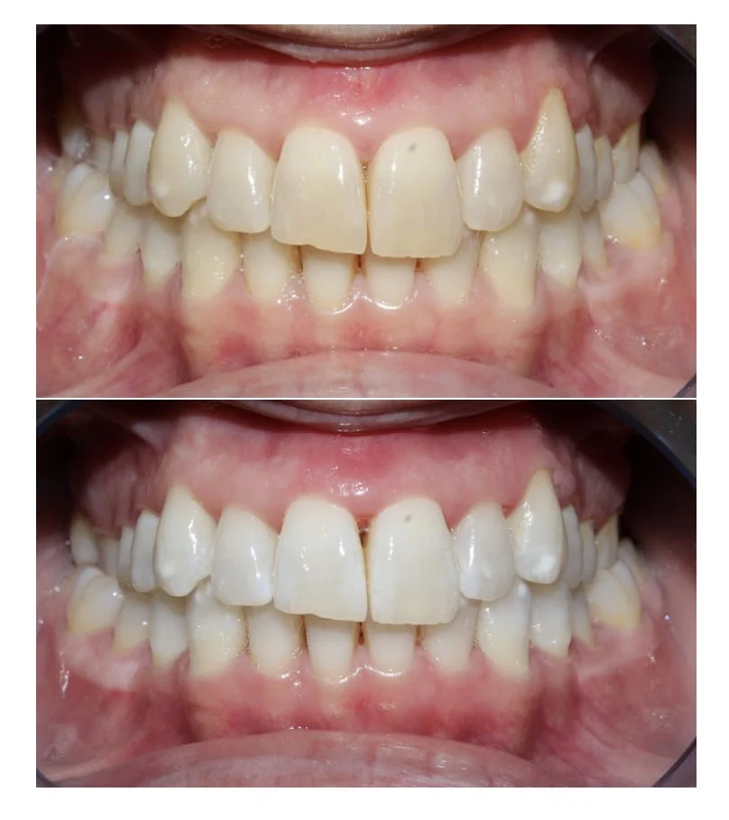 blanqueamiento dental en sevilla