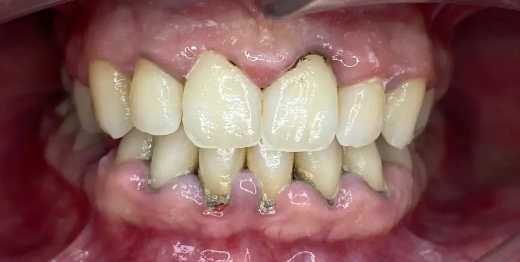 periodoncia antes
