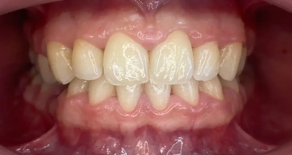 periodoncia despues